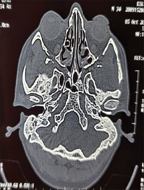 High-resolution computed tomography temporal bone axial cut showing bony erosion posteriorly in external canal.